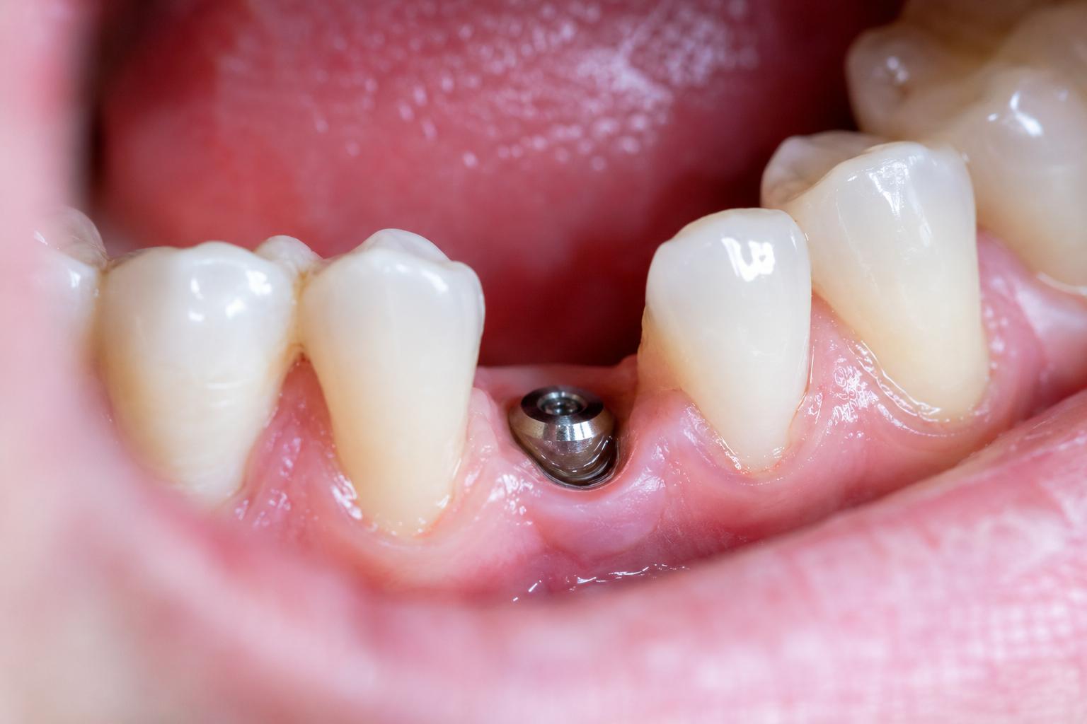 Dental Implants